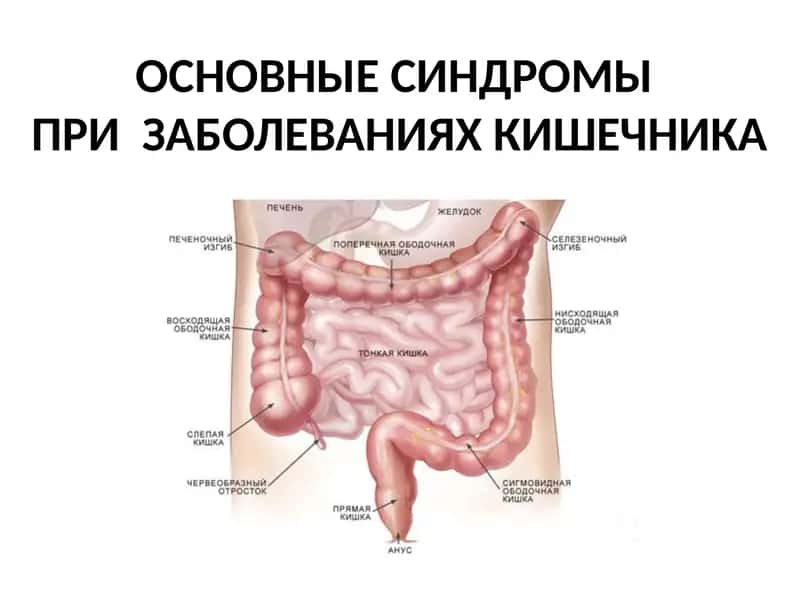 ОСНОВНЫЕ СИНДРОМЫ ПРИ ЗАБОЛЕВАНИЯХ КИШЕЧНИКА