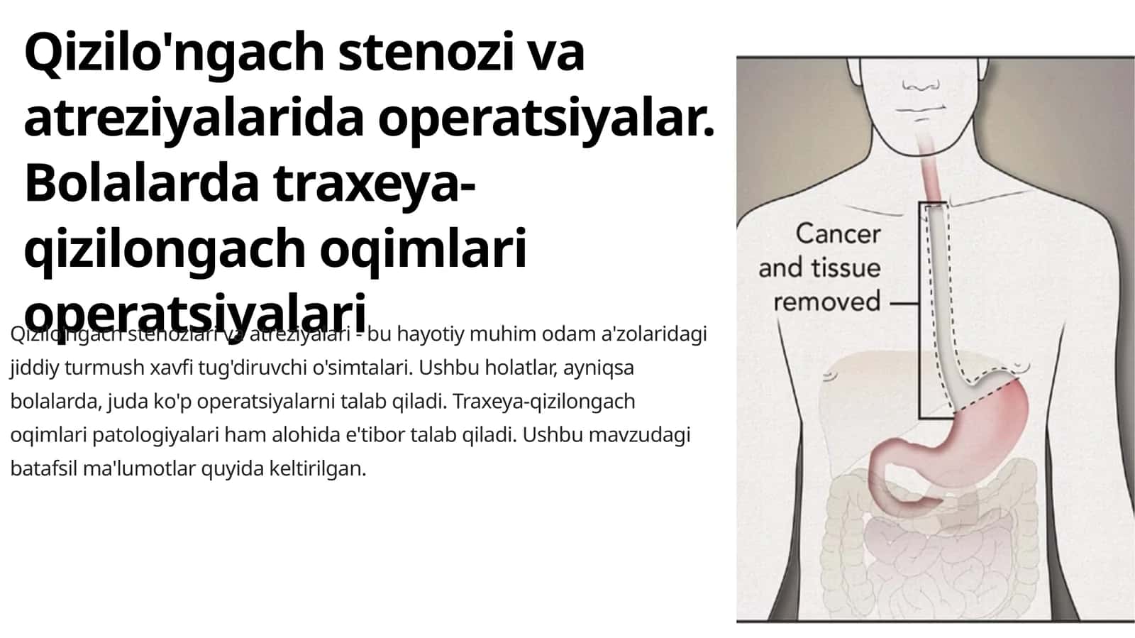 Qizilo'ngach stenozi va atreziyalarida operatsiyalar. Bolalarda traxeya-qizilongach oqimlari operatsiyalari