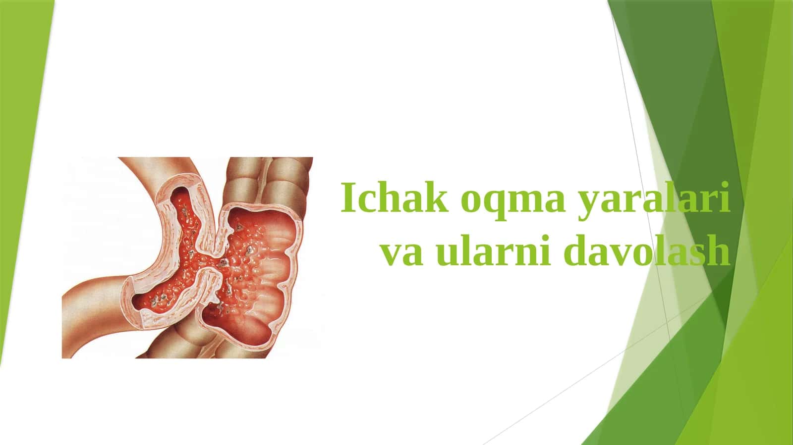 Ichakoqmayaralar va ularni davolash