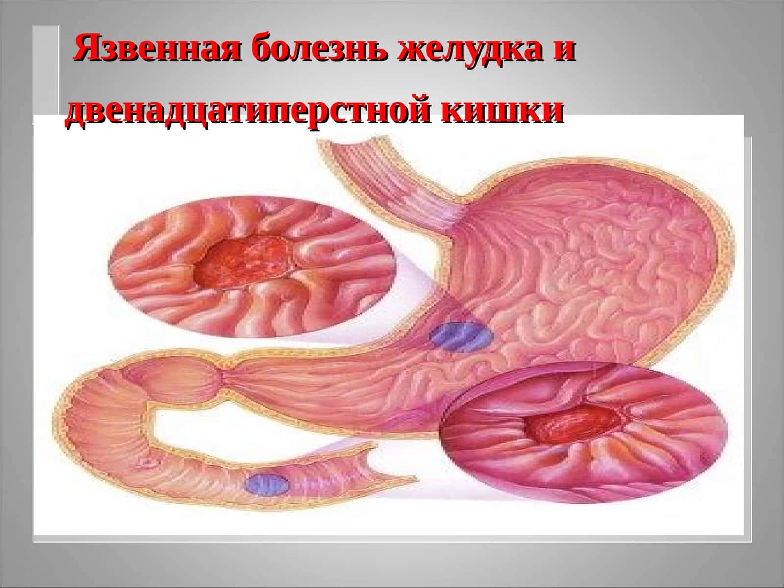 Язвенная болезньжелудка и двенадцатиперстной кишки