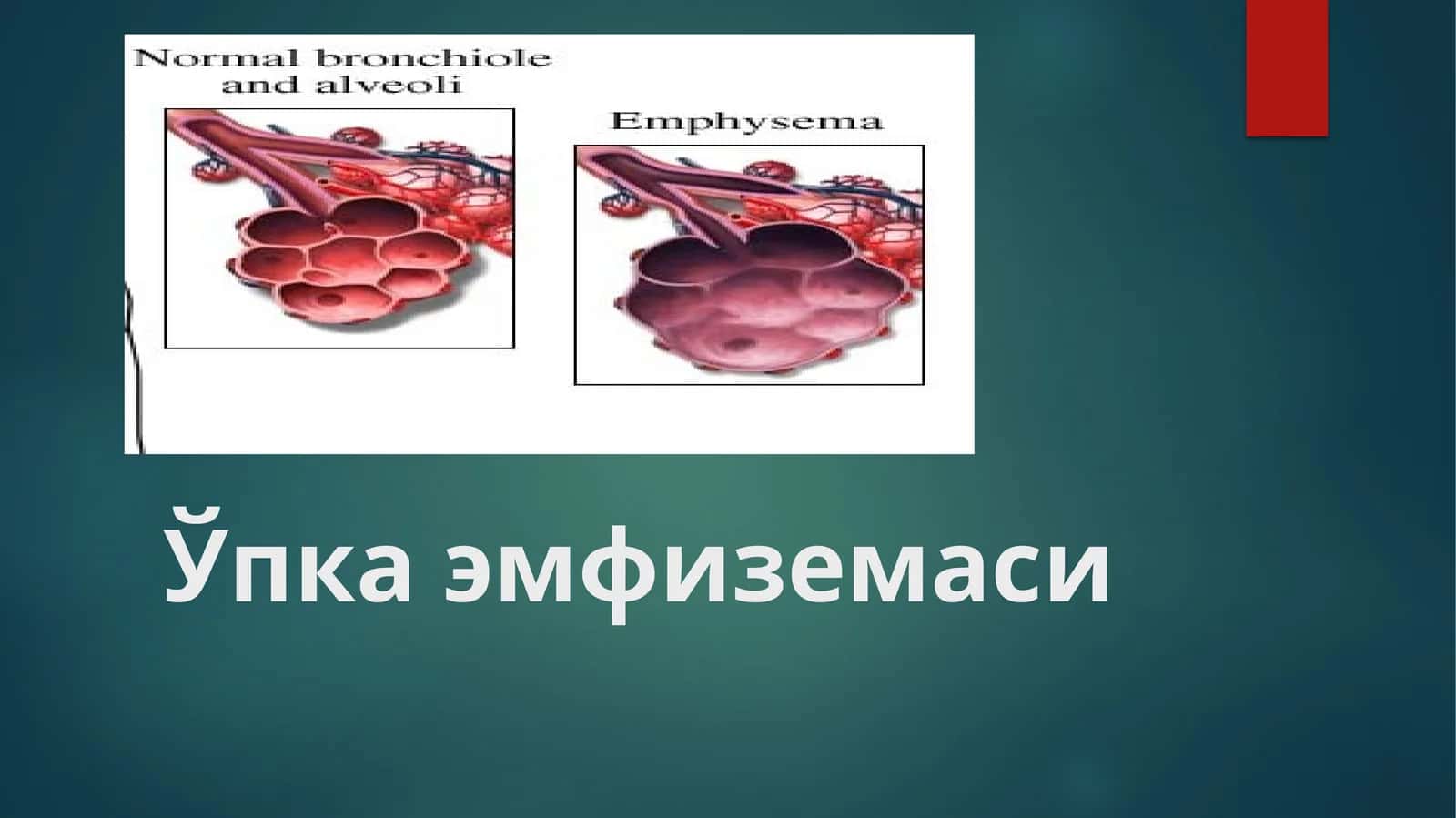 Ўпка эмфиземаси (o'ka emfuzemasi)