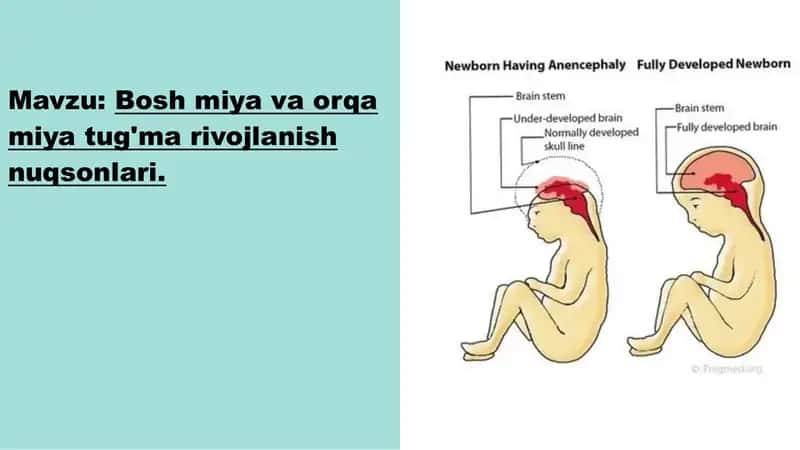 Bosh miya va orqa miya tug'ma rivojlanish nuqsonlari