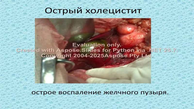 Острый холецистит