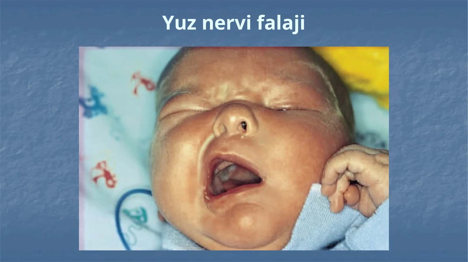 Yuz nervi falaji