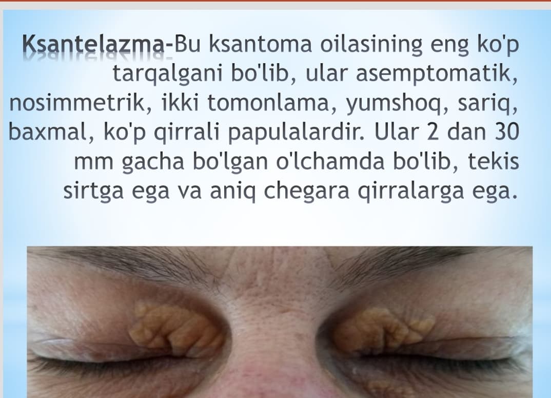 Ksantelazma , lipoma , gigroma