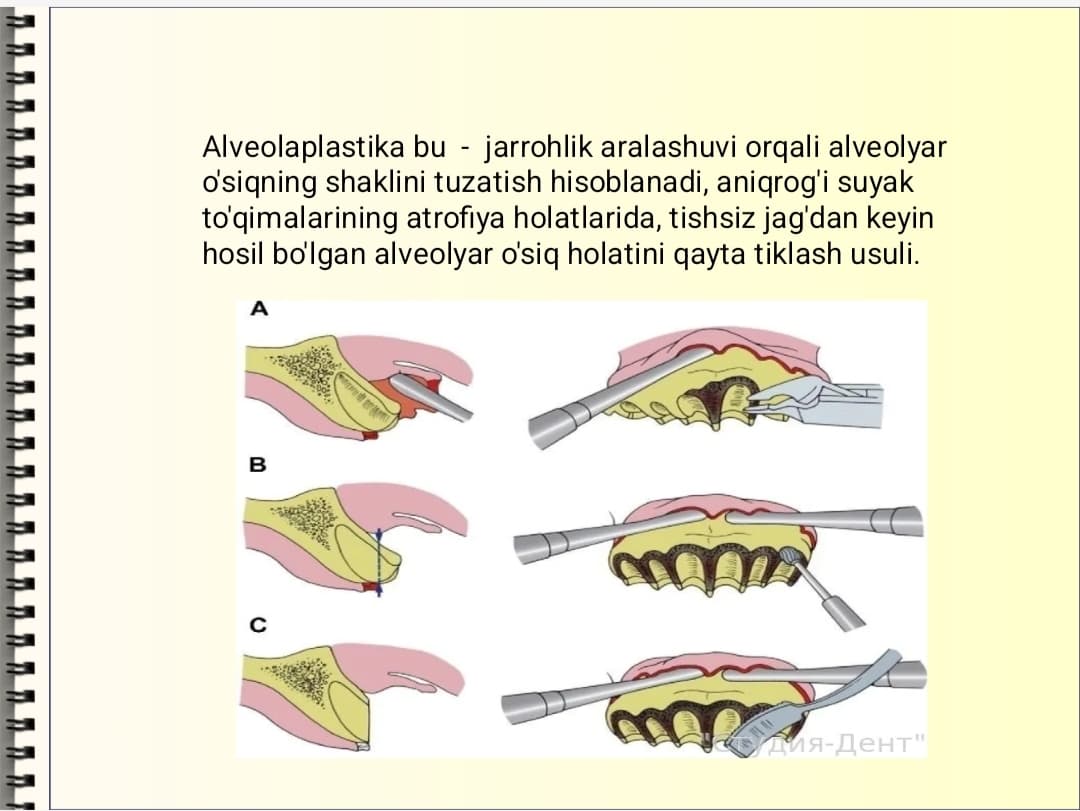 Alveolaplastika.Ko'rsatma va qarshi ko'rsatma