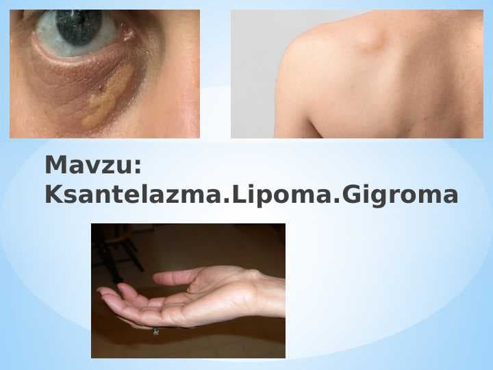 Gidrona va lipoma ppt