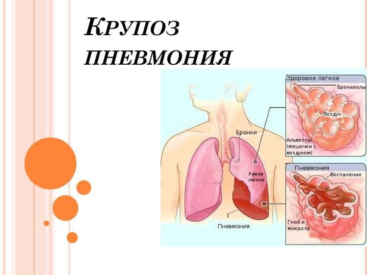 Krupoz pnevmoniya