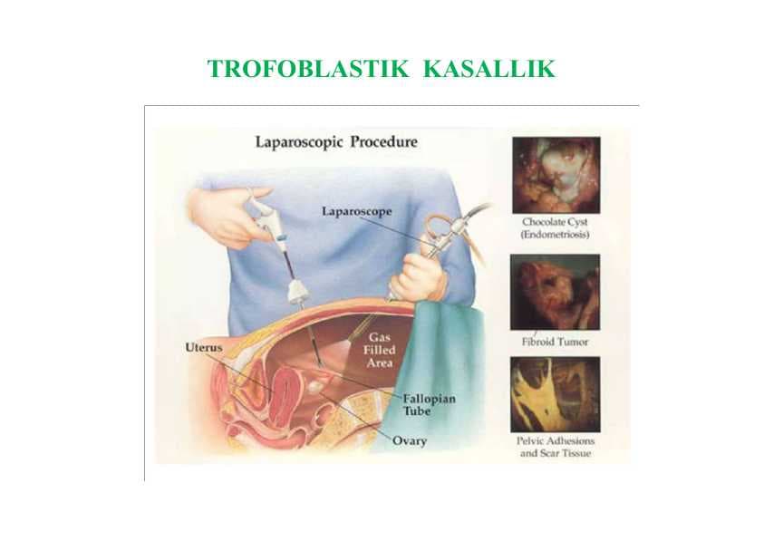 TROFOBLASTIK  KASALLIK
