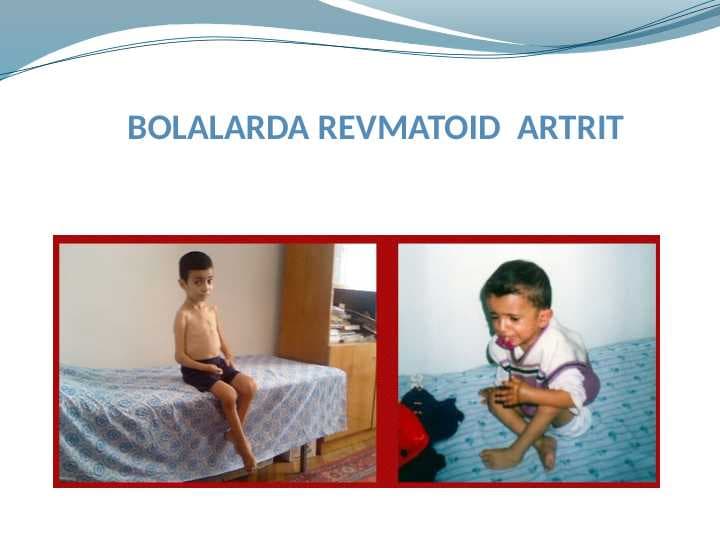 BOLALARDA REVMATOID  ARTRIT