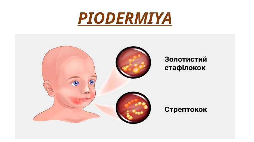 PIODERMIYA - ПИОДЕРМИЯ