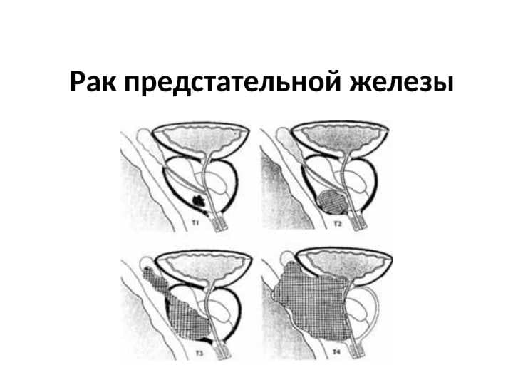 Рак предстательной железы
