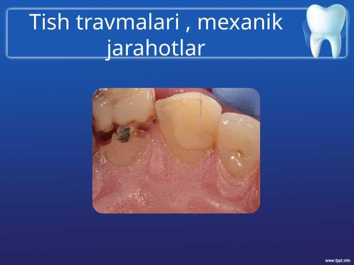 Tish travmalari , mexanik jarahotlar