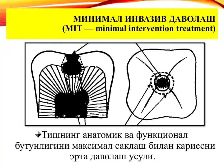 Minimal invaziv davolash (MIT — minimal intervention treatment)