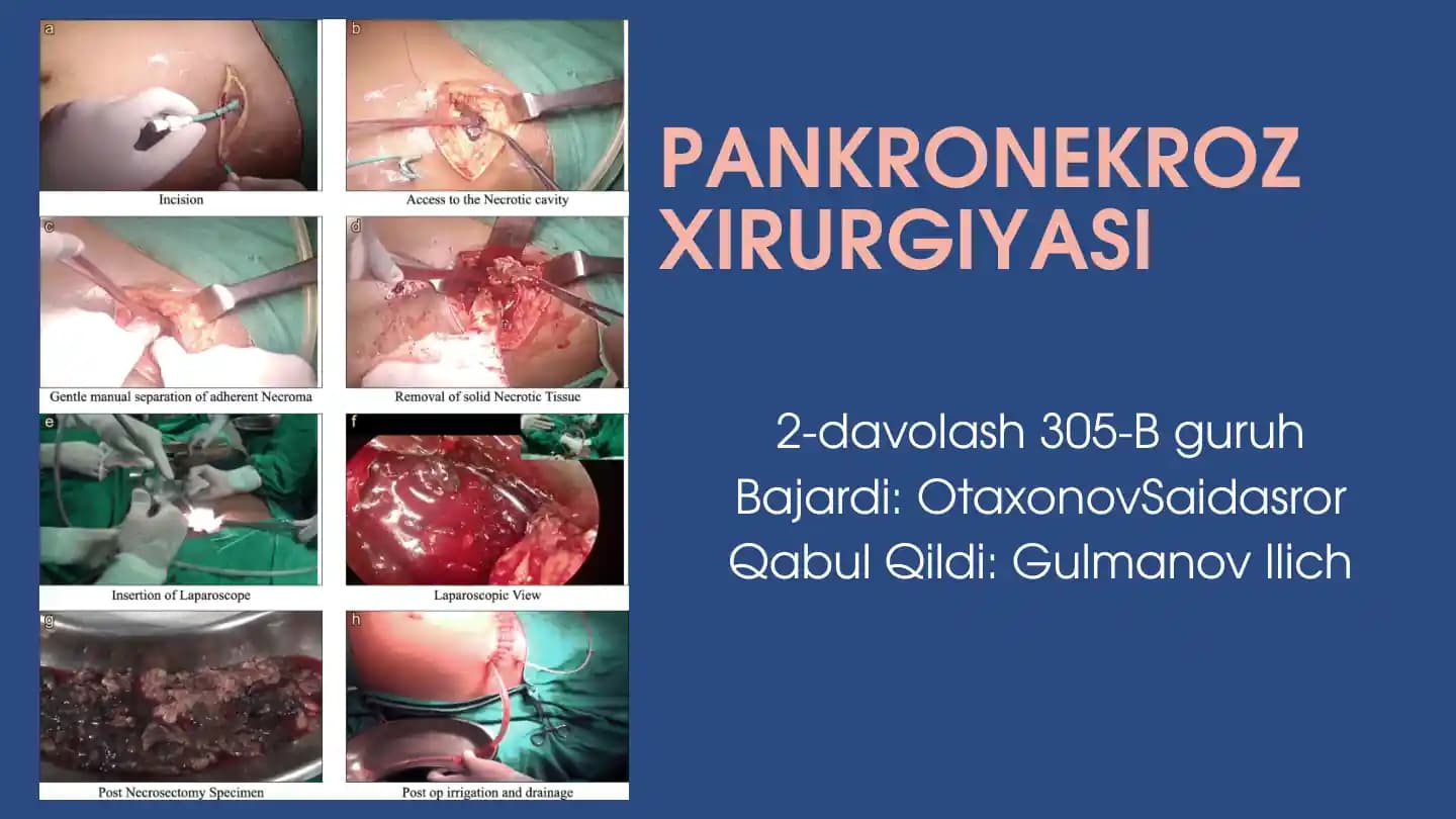 Pankronekroz Xirurgiyasi