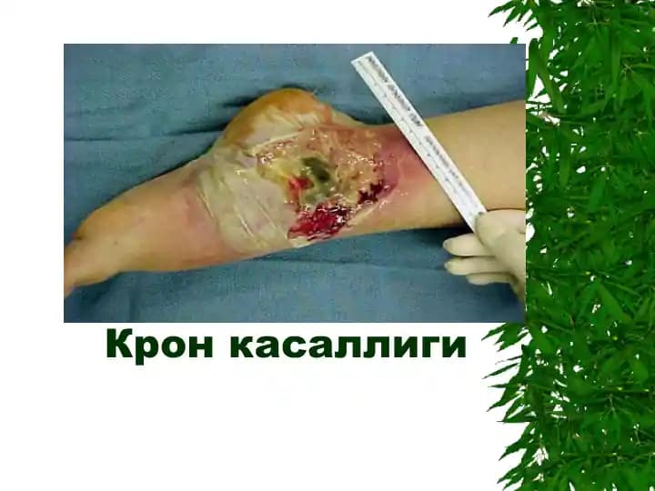 Крон касаллиги (Crohn's disease)