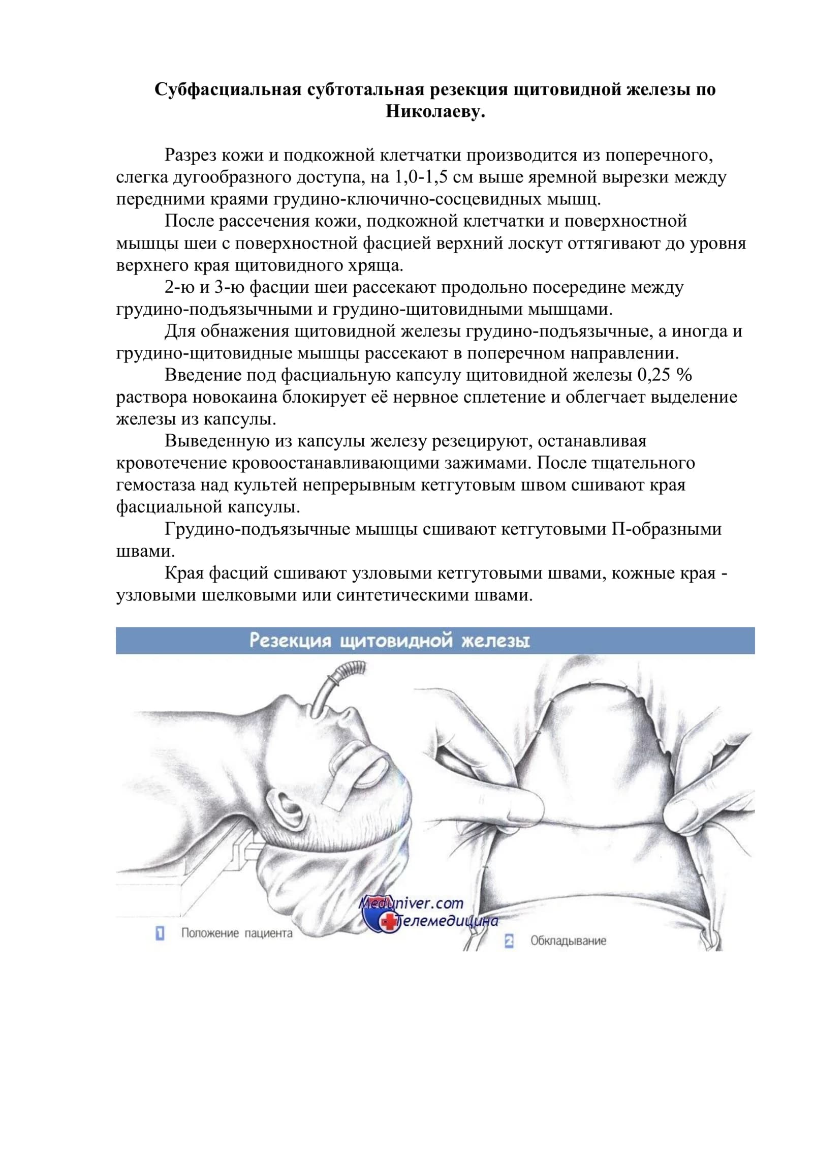 Субфасциальная субтотальная резекция щитовидной железы по Николаеву