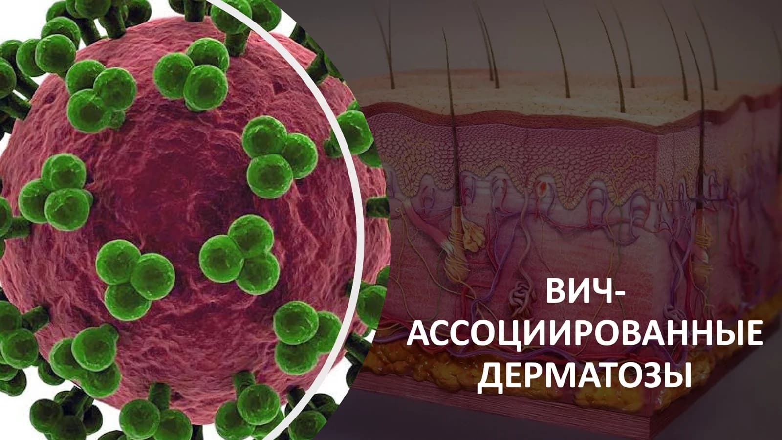 ВИЧ-АССОЦИИРОВАННЫЕ ДЕРМАТОЗЫ