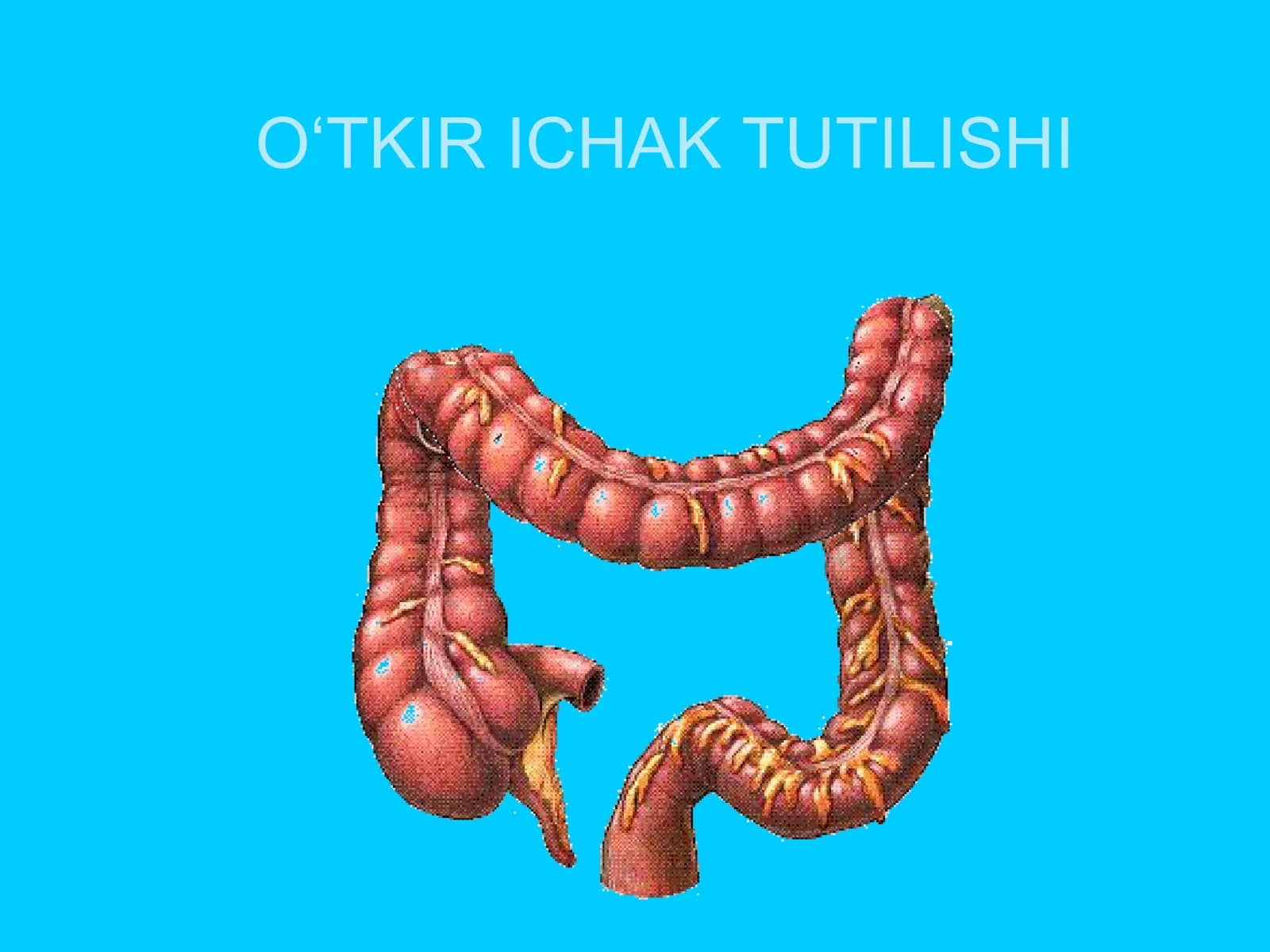 O‘TKIR ICHAK TUTILISHI
