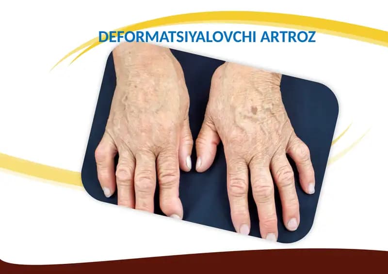 Deformatsiyalovchi Artroz