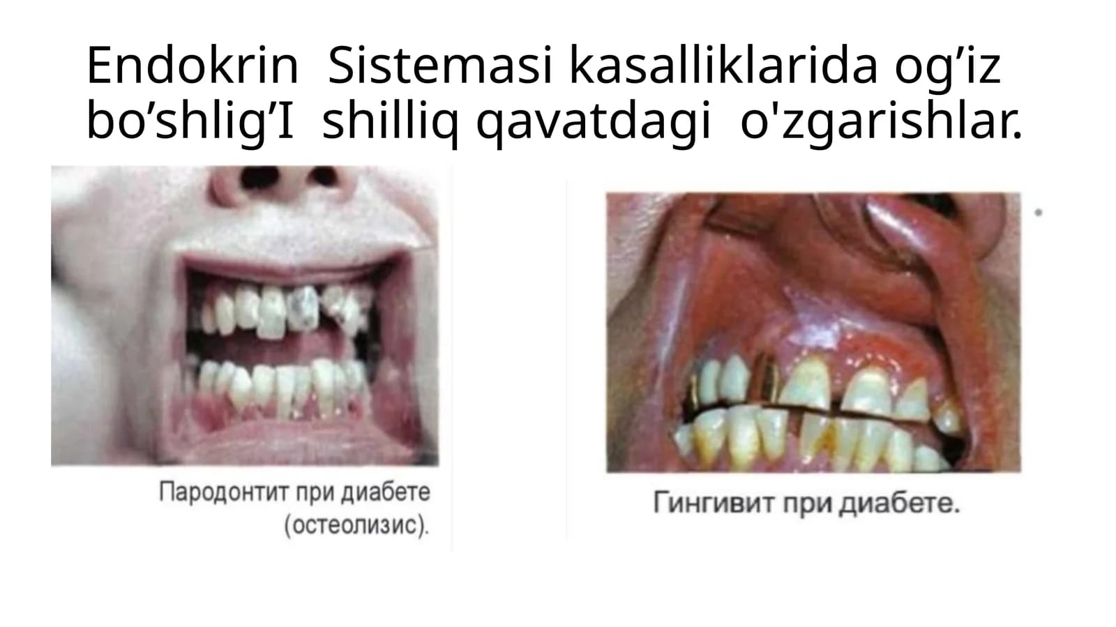 Endokrin Sistemasi kasalliklarida og’iz bo’shlig’I shilliq qavatdagi o'zgarishlar