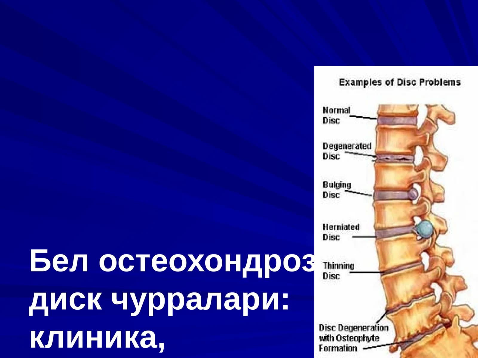 Бел остеохондрози, дискчурралари: клиника, диагностика, хирургик давоси
