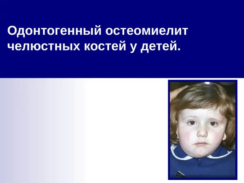 Одонтогенный остеомиелит челюстных костей у детей