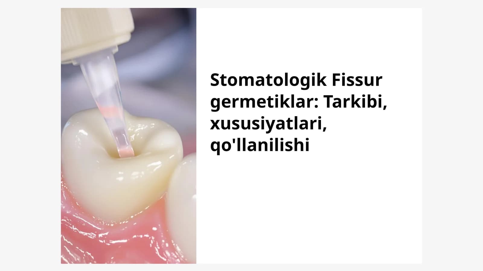 Stomatologik Fissur germetiklar: Tarkibi, xususiyatlari, qo'llanilishi