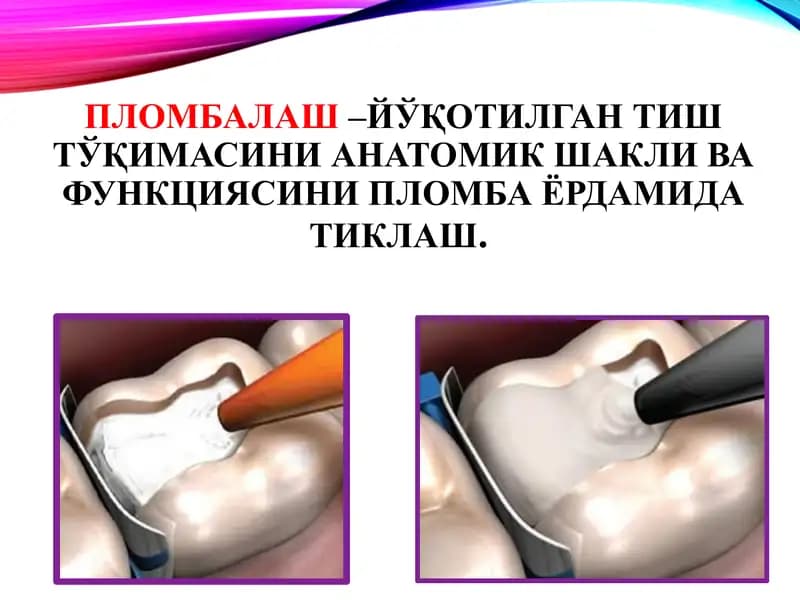 Stomatologiyada ishlatiladigan Plomba ashyolari PPTX