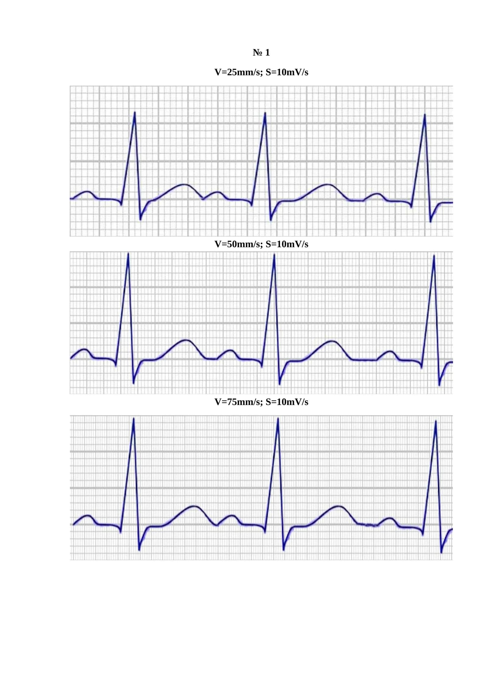 V=25mm/s; S=10mV/s
