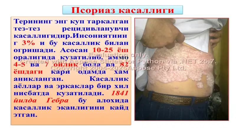 Псориаз касаллиги