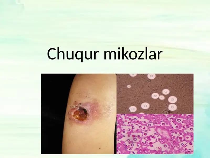 Chuqur mikozlar