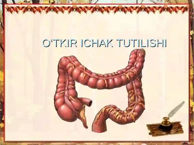 O‘TKIR ICHAK TUTILISHI