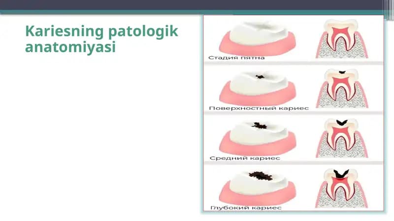 Kariesning patologika anatomiyasi
