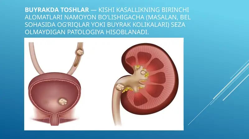 Siydik tosh kasalligi