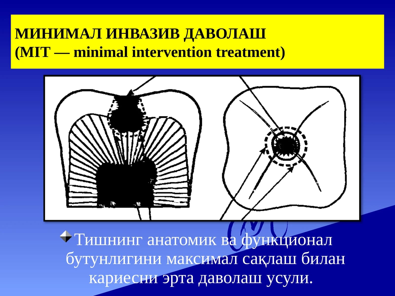 МИНИМАЛИНВАЗИВ ДАВОЛАШ(MIT—minimalinterventiontreatment)