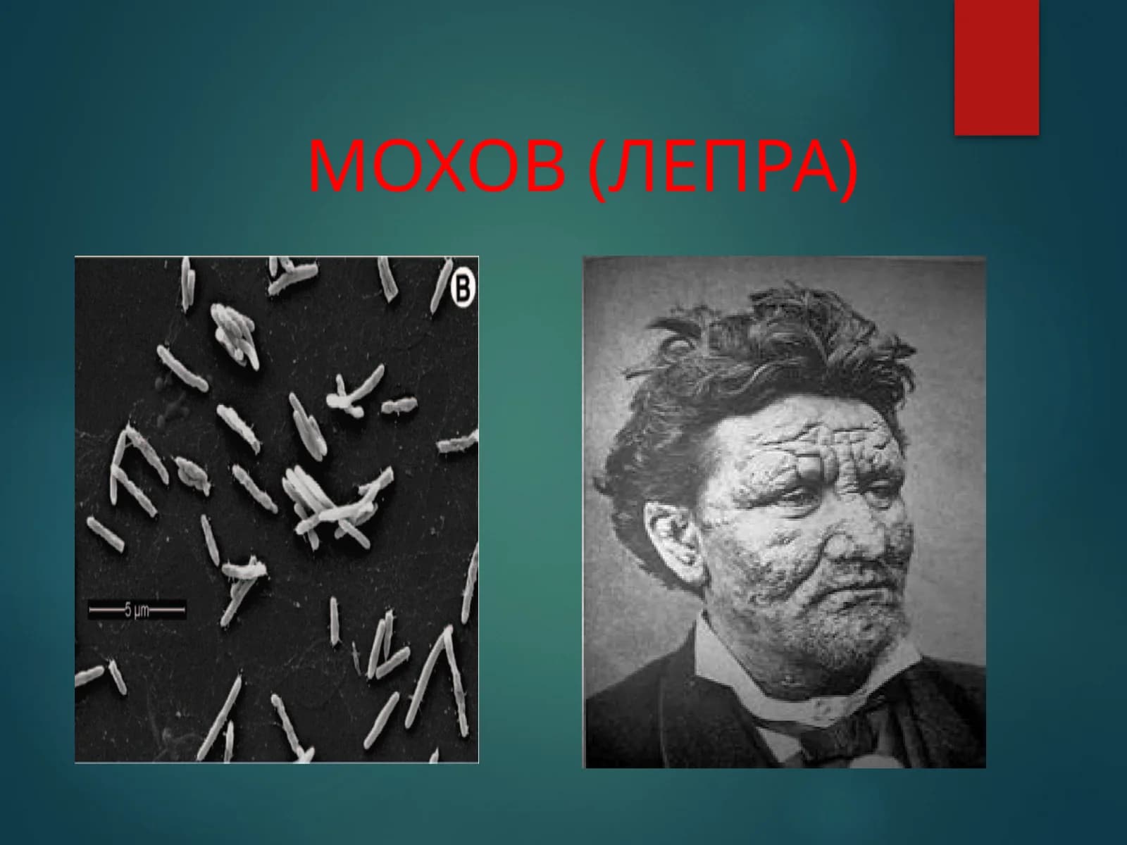 МОХОВ (ЛЕПРА)