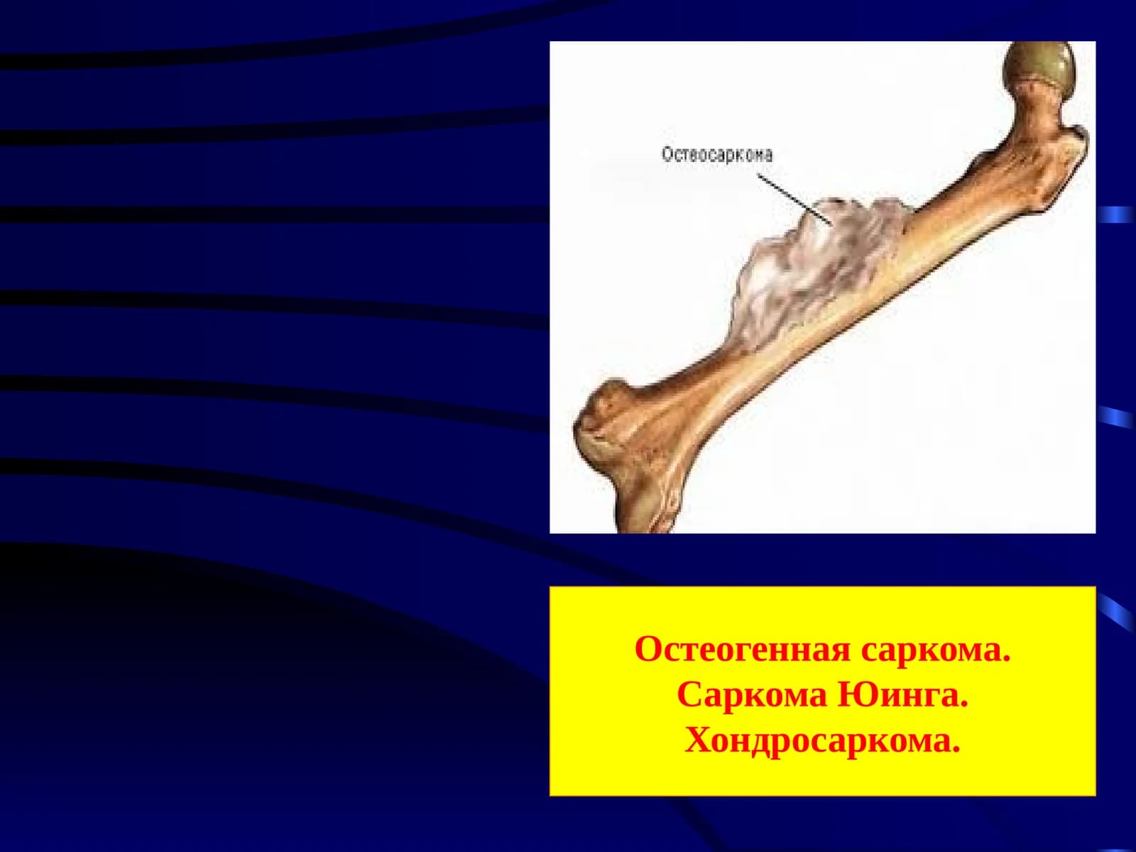 Остеогенная саркома. Саркома Юинга. Хондросаркома