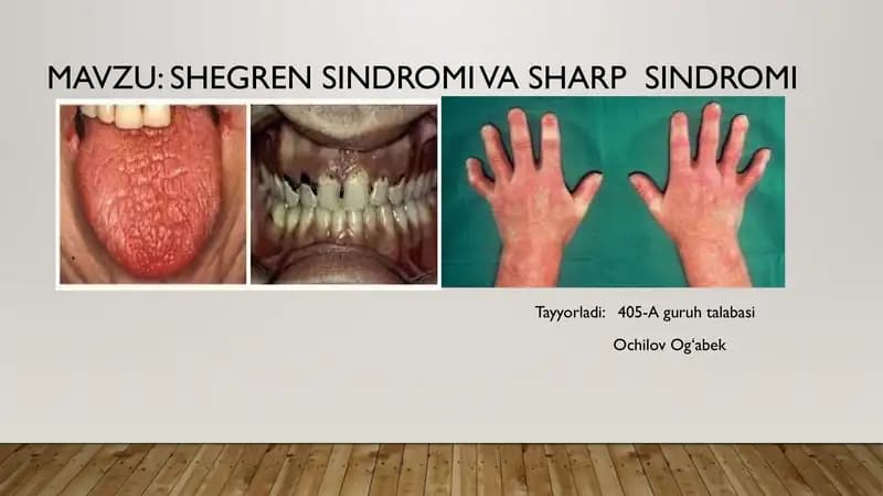 Shegren sindromi va Sharp sindromi