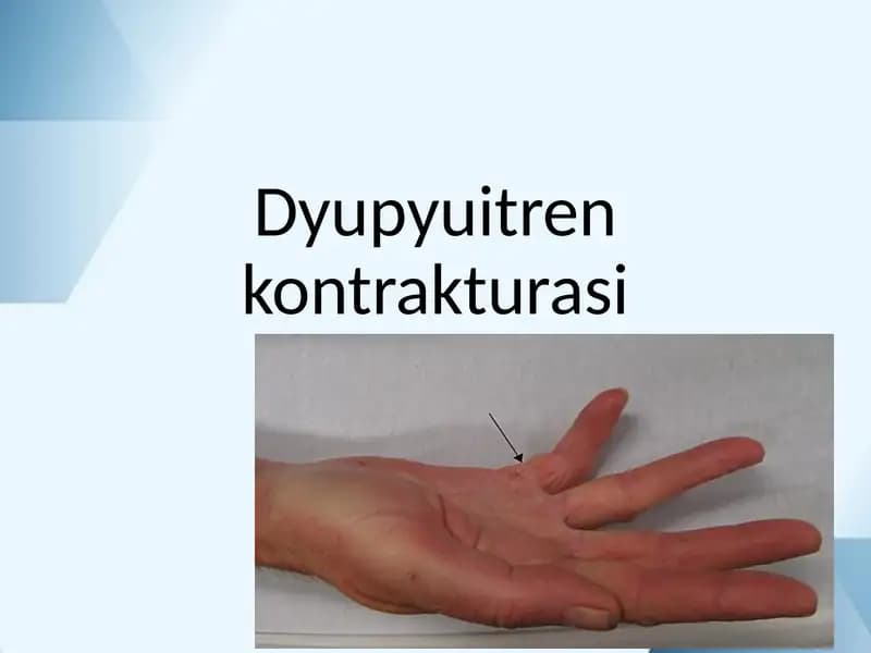 Dyupyuitren kontrakturasi