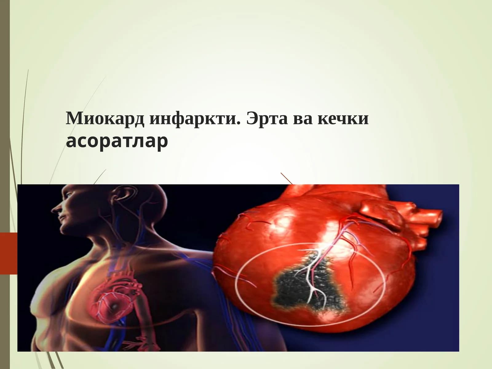 Миокард инфаркти. Эрта ва кечки асоратлар