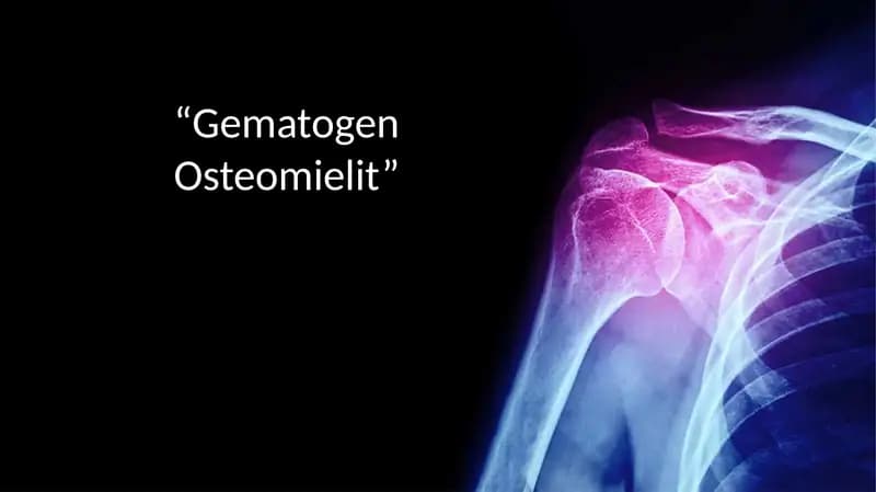 Gematogen osteomiyelit mustaqil ish  . tibbiyot