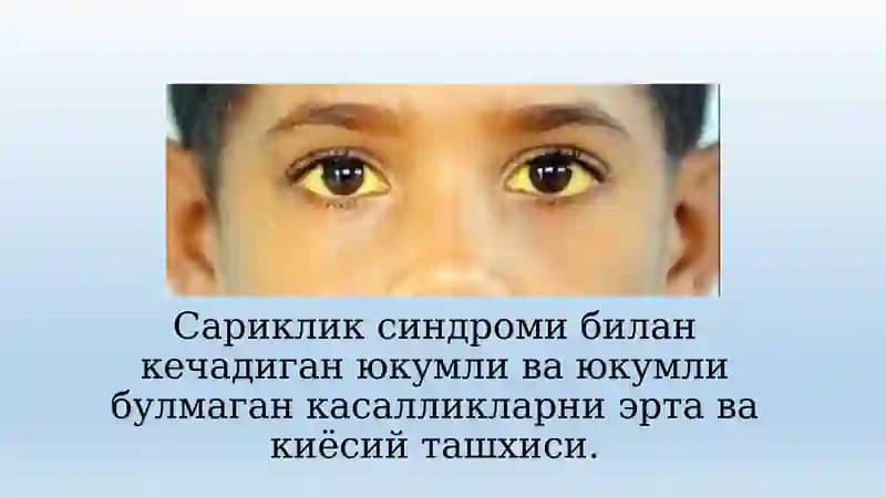 Сариклик синдроми