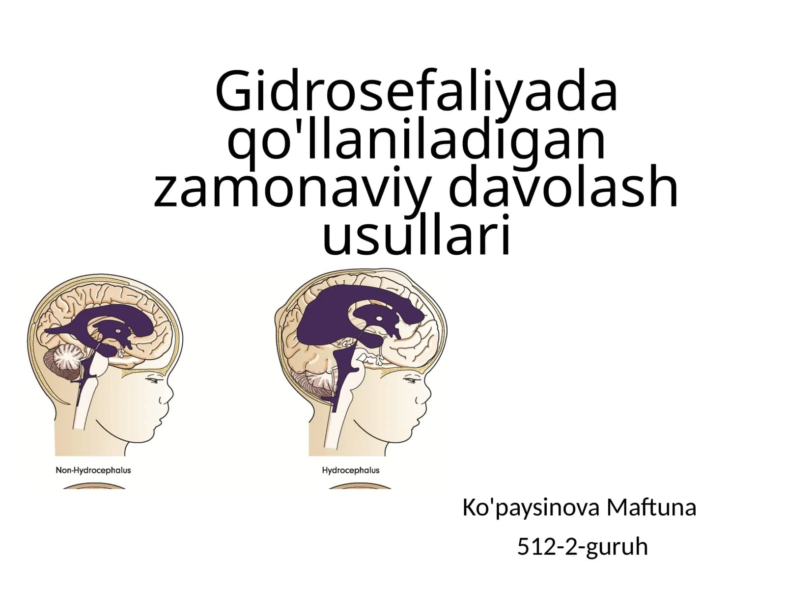 Gidrosefaliyada qo'llaniladigan zamonaviy davolash usullari