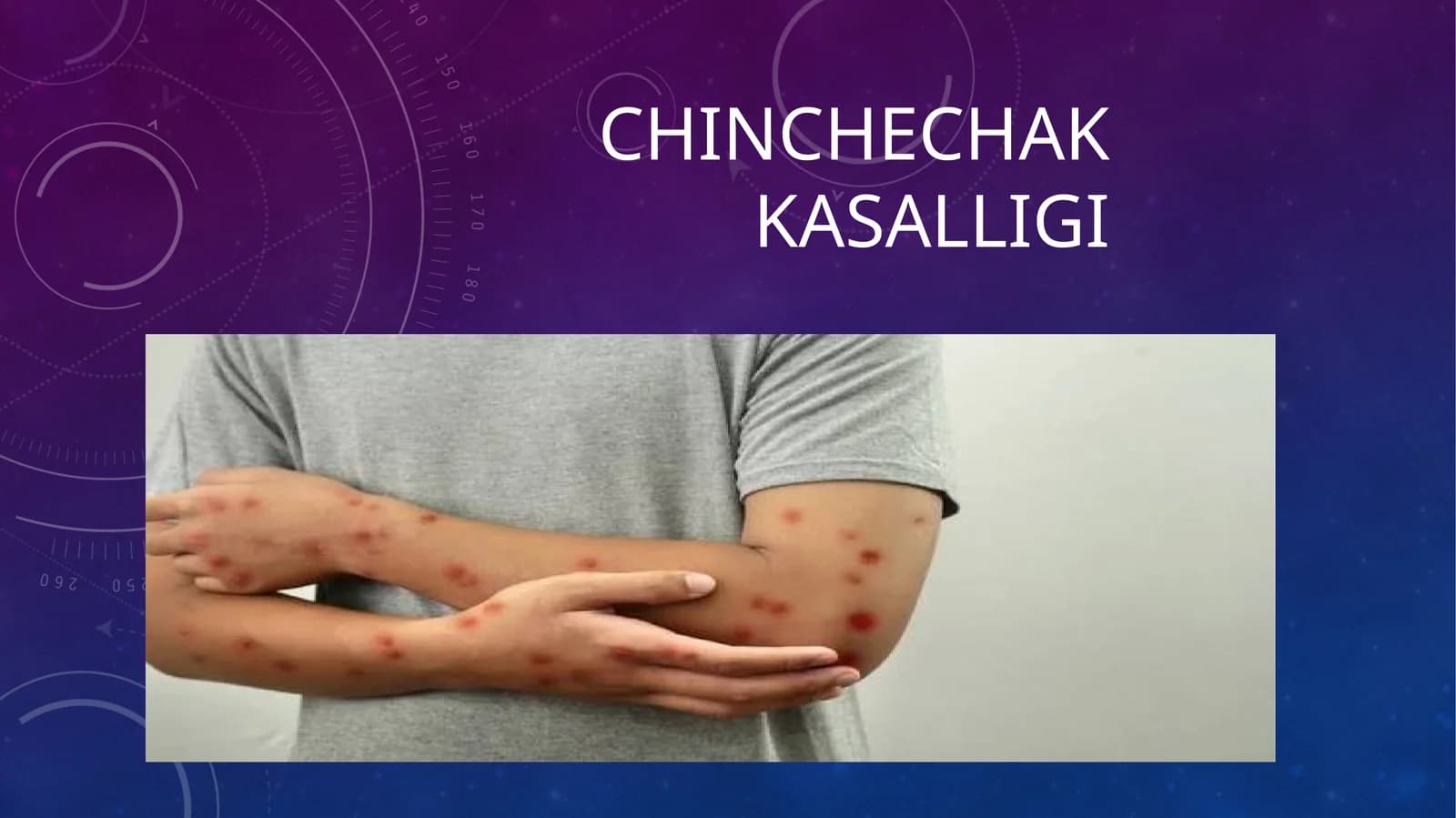Chinchechak kasalligi