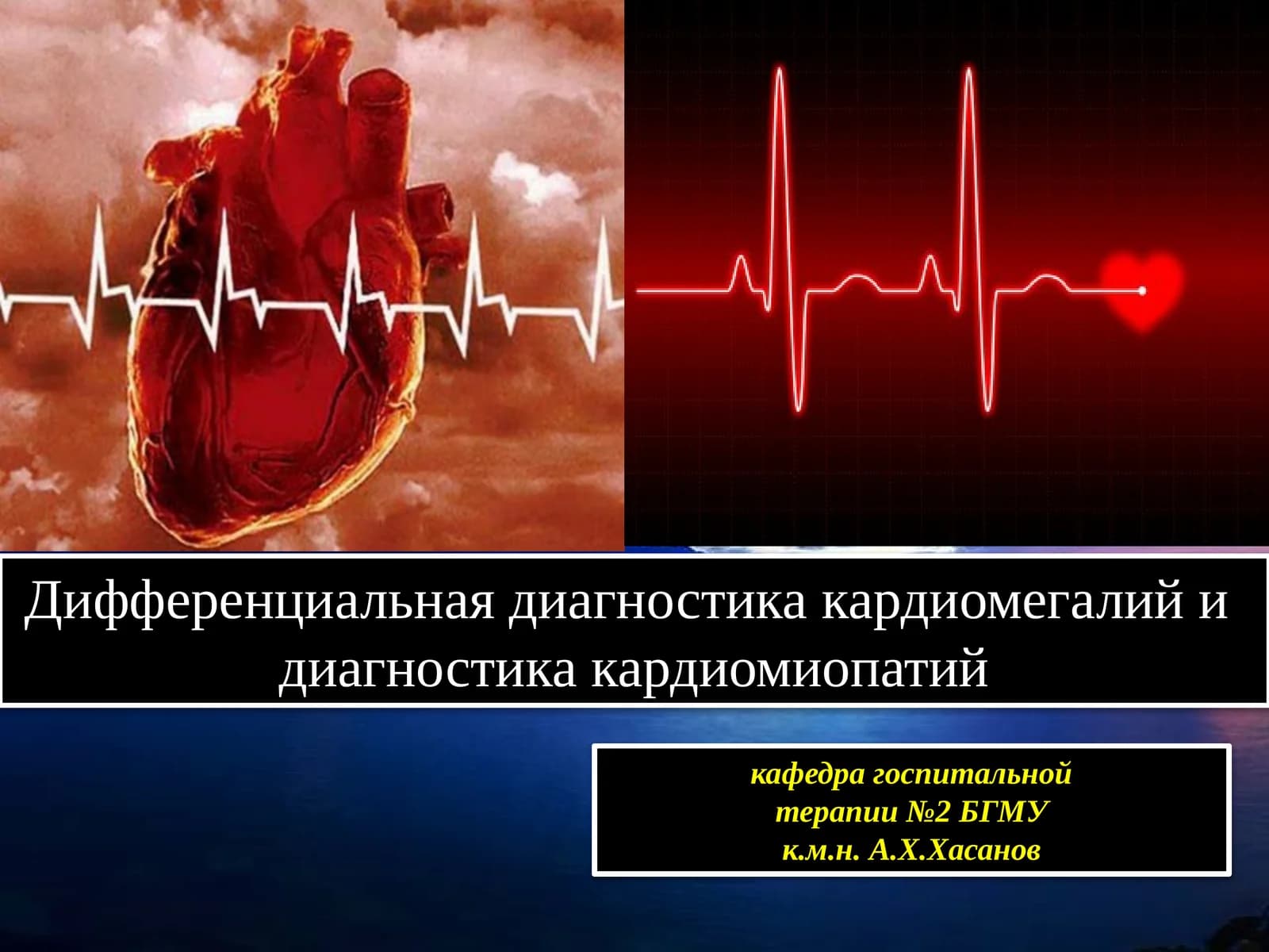Дифференциальная диагностика кардиомегалий