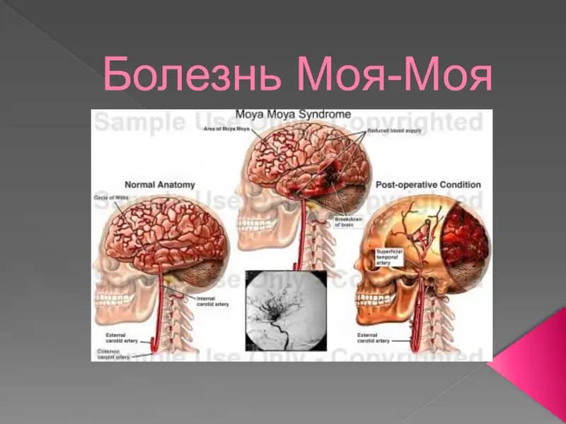 Болезнь Моя-Моя