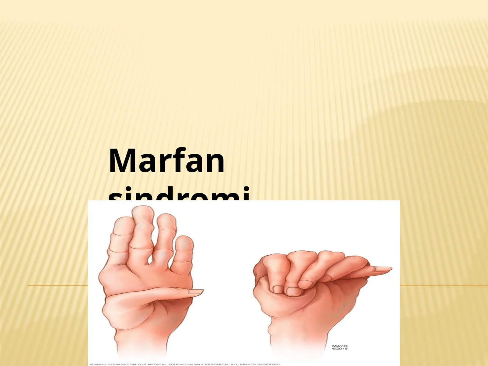 Marfan sindromi