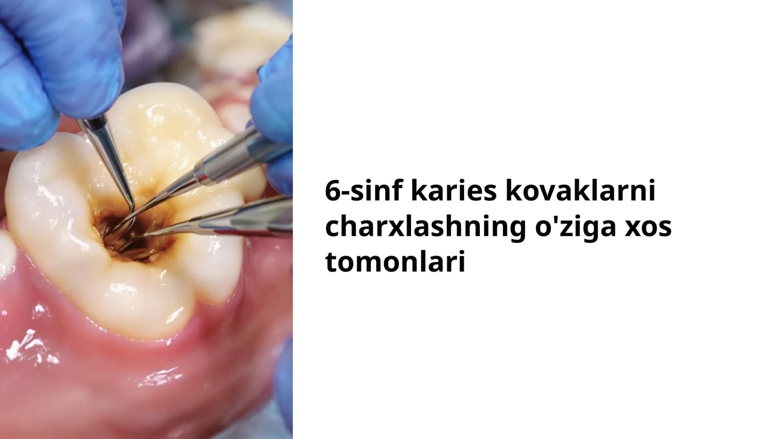 6-sinf karies kovaklarni charxlashning o'ziga xos tomonlari