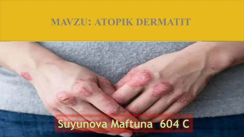 ATOPIK DERMATIT